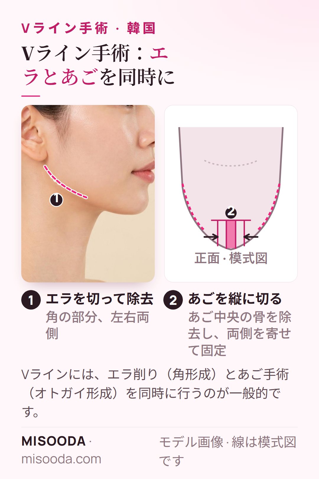 韓国 Vライン手術:左右のエラの角を切って除去し、あごを縦に切って中央の骨を除去して内側に寄せる模式図