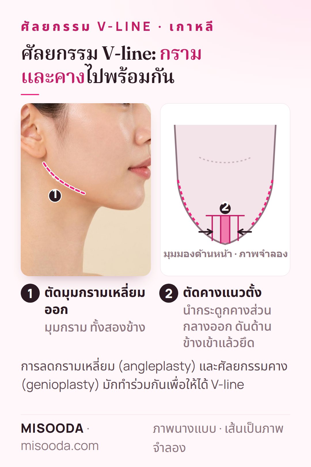 ศัลยกรรม V-line เกาหลี: ตัดมุมกรามเหลี่ยมทั้งสองข้าง ตัดคางแนวตั้งนำกระดูกคางส่วนกลางออกแล้วดันเข้า ภาพจำลอง