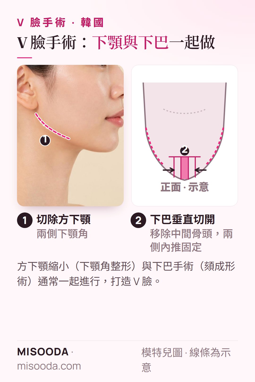 韓國 V 臉手術示意圖:切除兩側方下顎角,下巴垂直切開、移除中間的下巴骨後將兩側向內推並固定