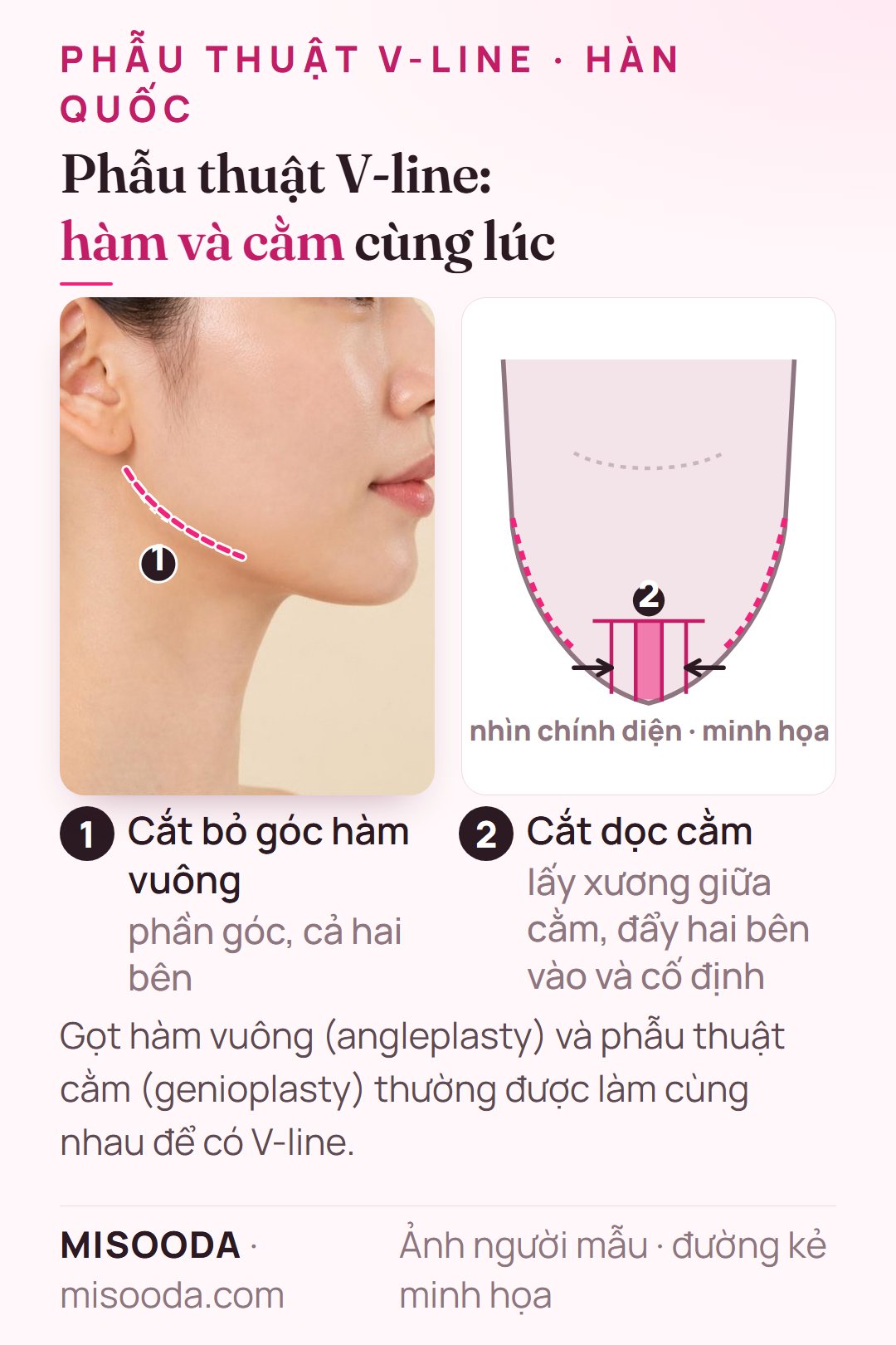 Phẫu thuật V-line Hàn Quốc: cắt bỏ góc hàm vuông hai bên, cắt dọc cằm lấy xương giữa và đẩy vào trong, minh họa