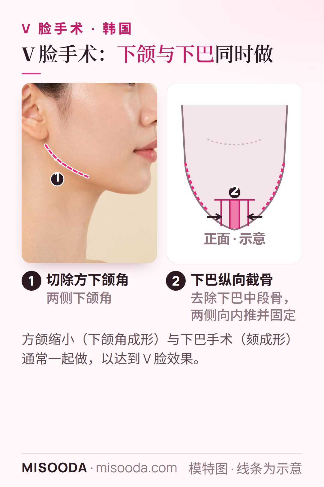 韩国 V 脸手术示意图:切除两侧方下颌角,下巴纵向截骨并去除中段骨后向内推,使脸型更纤细