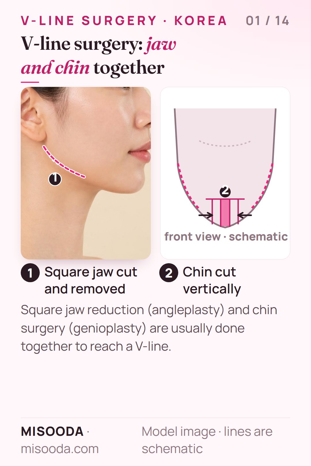 V-line surgery in Korea: square jaw angle cut and removed on both sides, chin cut vertically with the mid chin bone removed and pushed inward, schematic