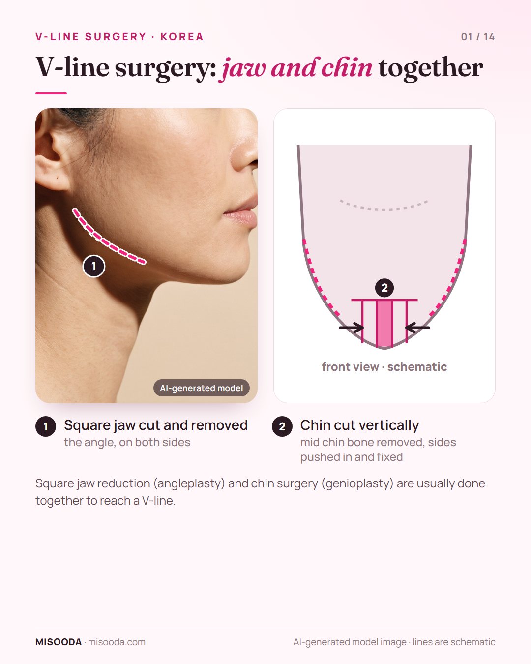 V-line surgery in Korea: square jaw angle cut and removed on both sides, chin cut vertically with the mid chin bone removed and pushed inward, schematic