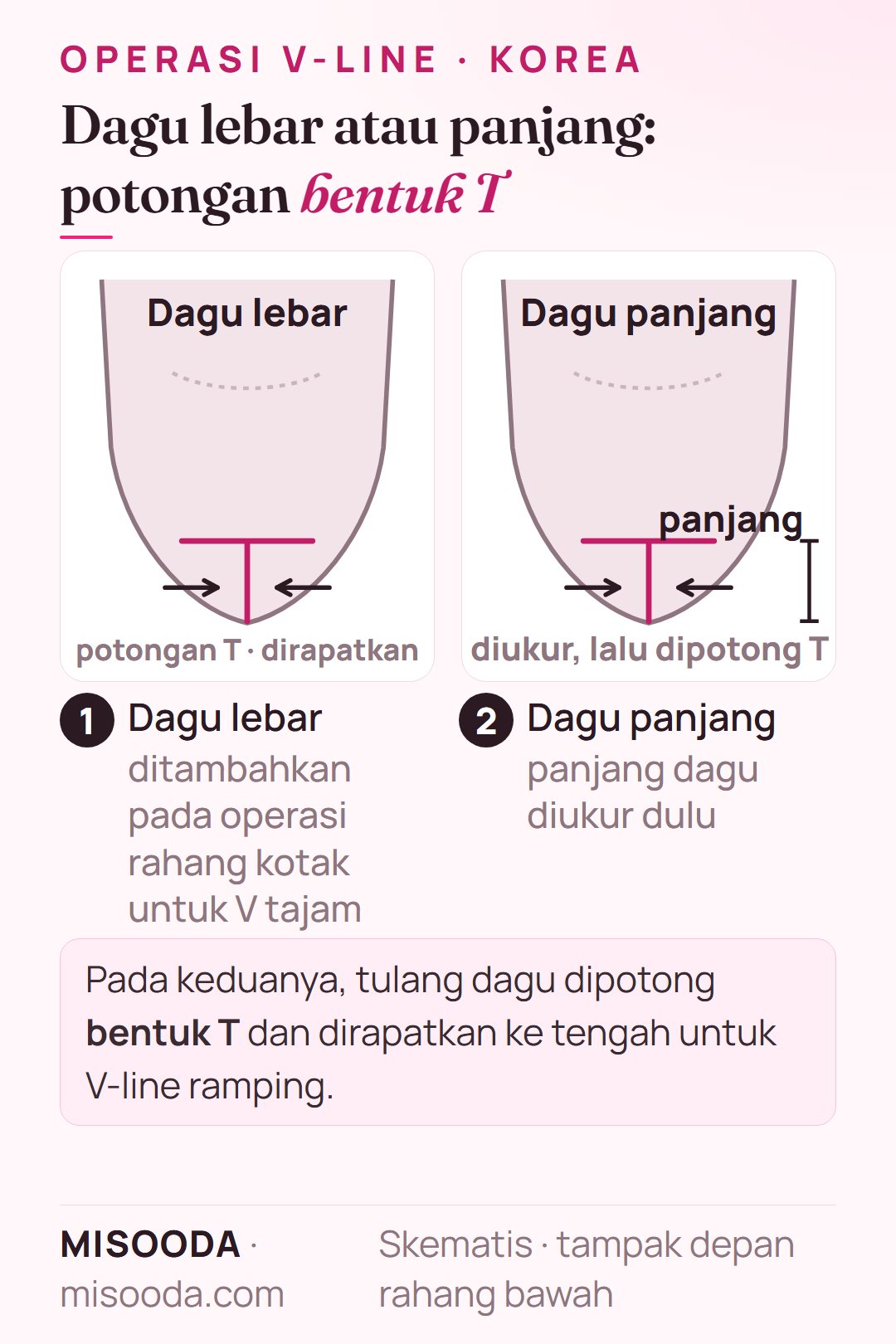 Pengecilan dagu lebar dan dagu panjang untuk V-line: tulang dagu dipotong bentuk T dan dirapatkan ke tengah, panjang dagu diukur dulu, skematis