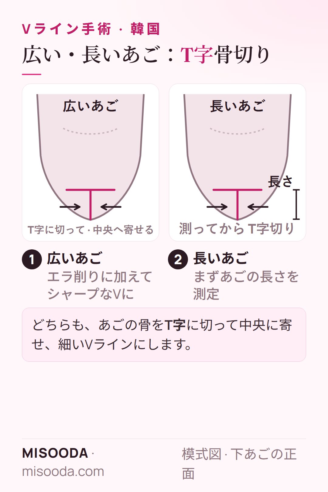 Vラインのための広いあご・長いあごの縮小:あごの骨をT字に切って中央に寄せ、長いあごは先に長さを測る模式図