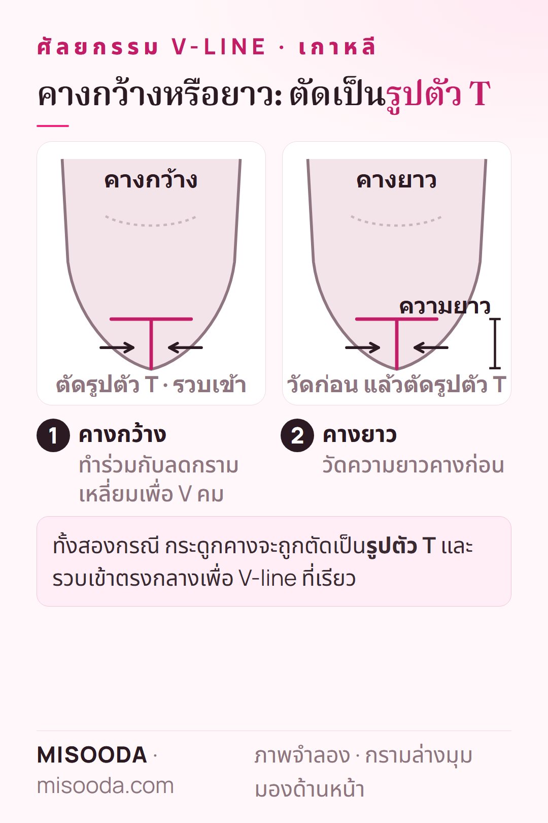 ลดคางกว้างและคางยาวสำหรับ V-line: ตัดกระดูกคางเป็นรูปตัว T แล้วรวบเข้าตรงกลาง โดยวัดความยาวคางก่อน ภาพจำลอง
