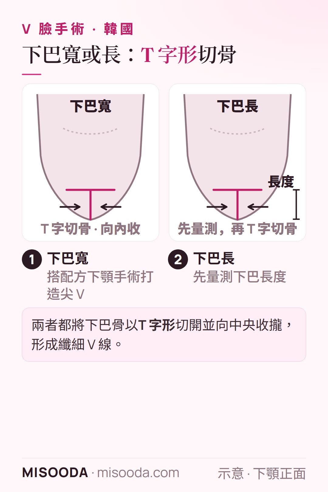 韓國 V 臉 下巴寬與下巴長矯正示意:下巴骨以 T 字形切開並向中央收攏,下巴長度先量測