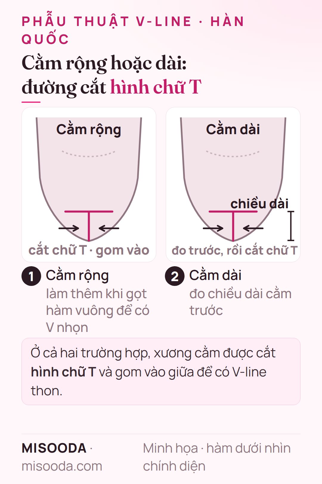 Thu gọn cằm rộng và cằm dài cho V-line: xương cằm cắt hình chữ T và gom vào giữa, đo chiều dài cằm trước, minh họa