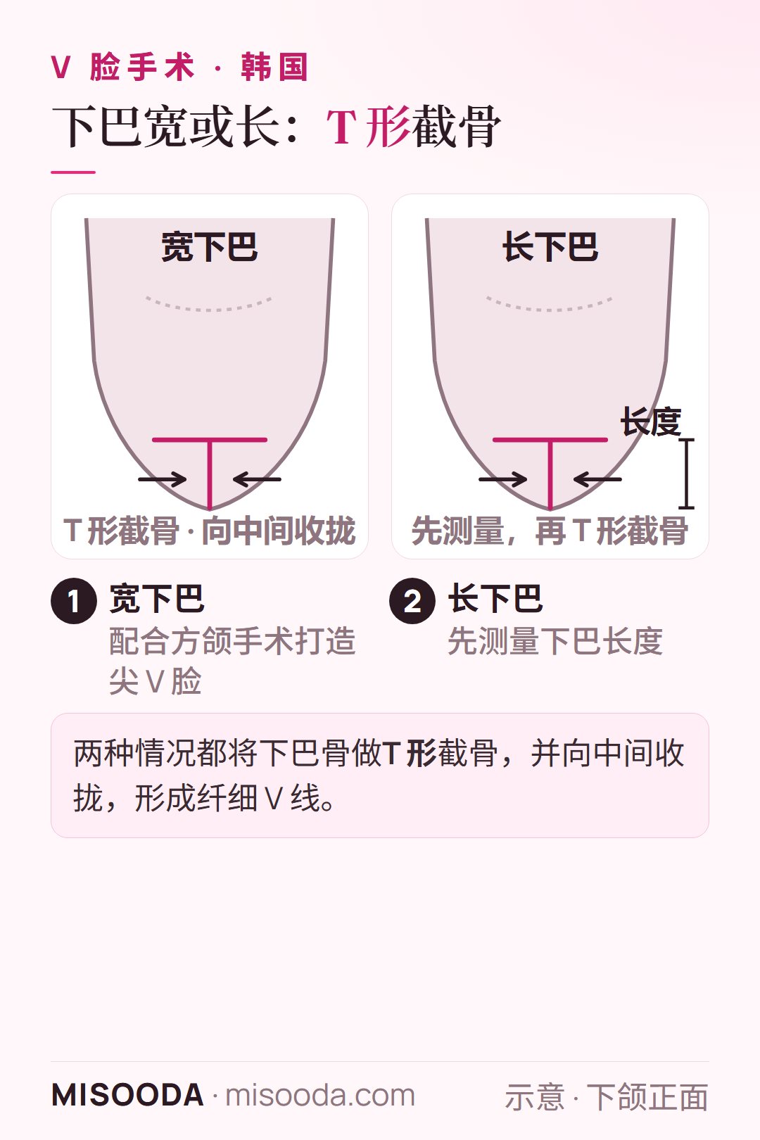 韩国 V 脸宽下巴与长下巴缩小示意图:下巴骨做 T 形截骨并向中间收拢,长下巴先测量长度