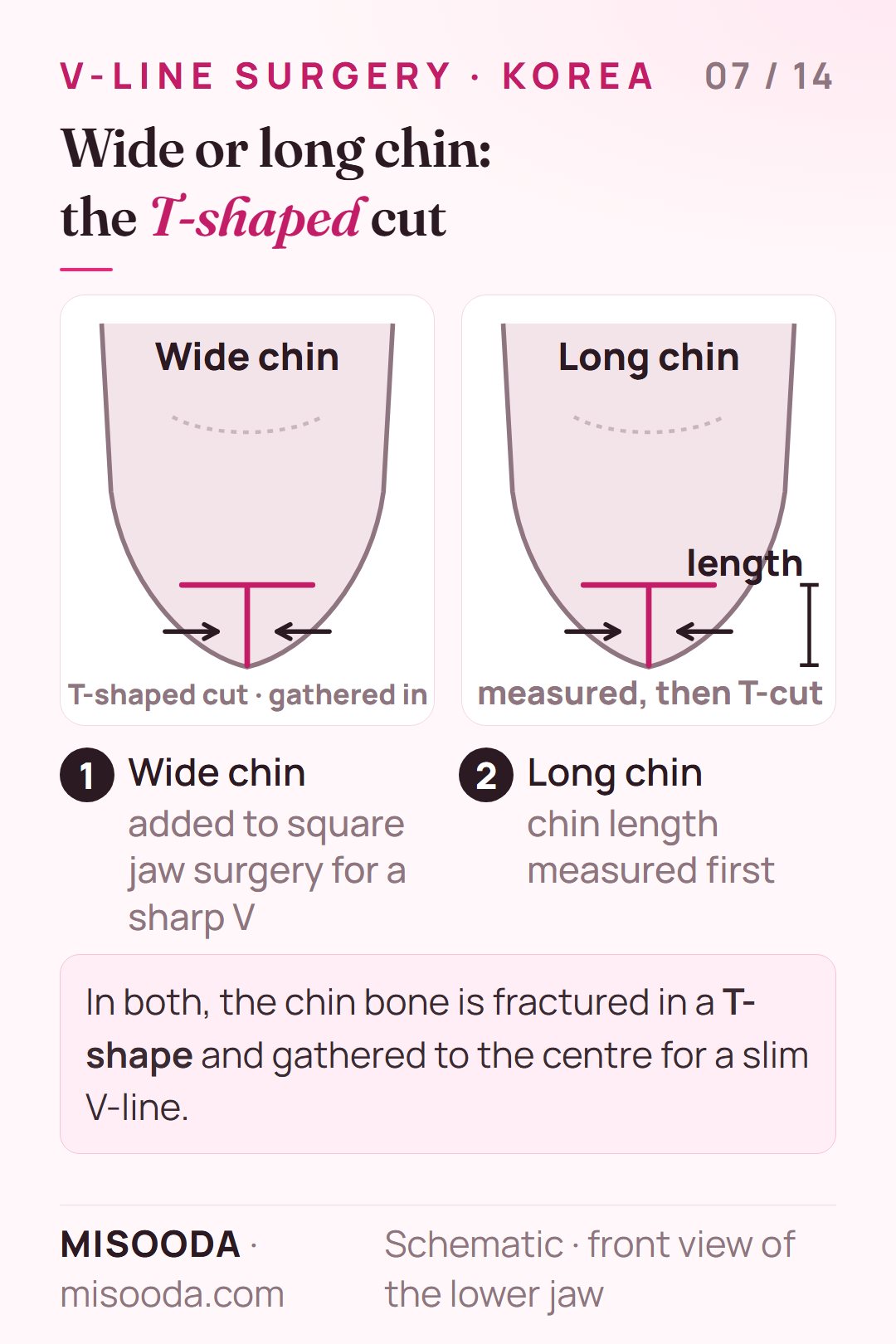 Wide chin and long chin reduction for V-line: the chin bone fractured in a T-shape and gathered to the centre, with chin length measured first, schematic