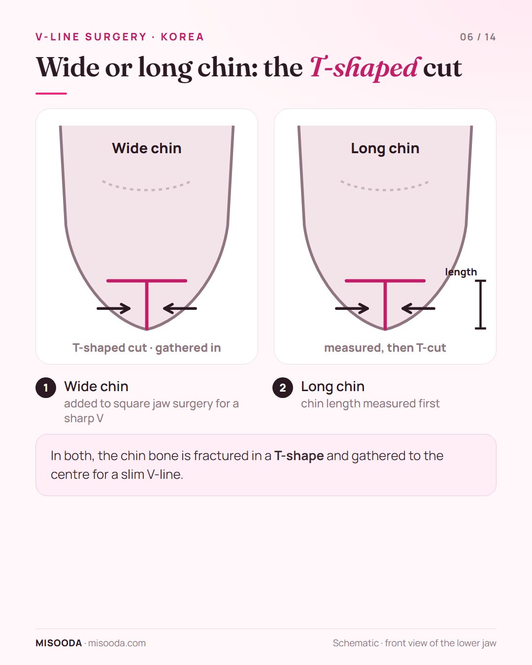 Wide chin and long chin reduction for V-line: the chin bone fractured in a T-shape and gathered to the centre, with chin length measured first, schematic