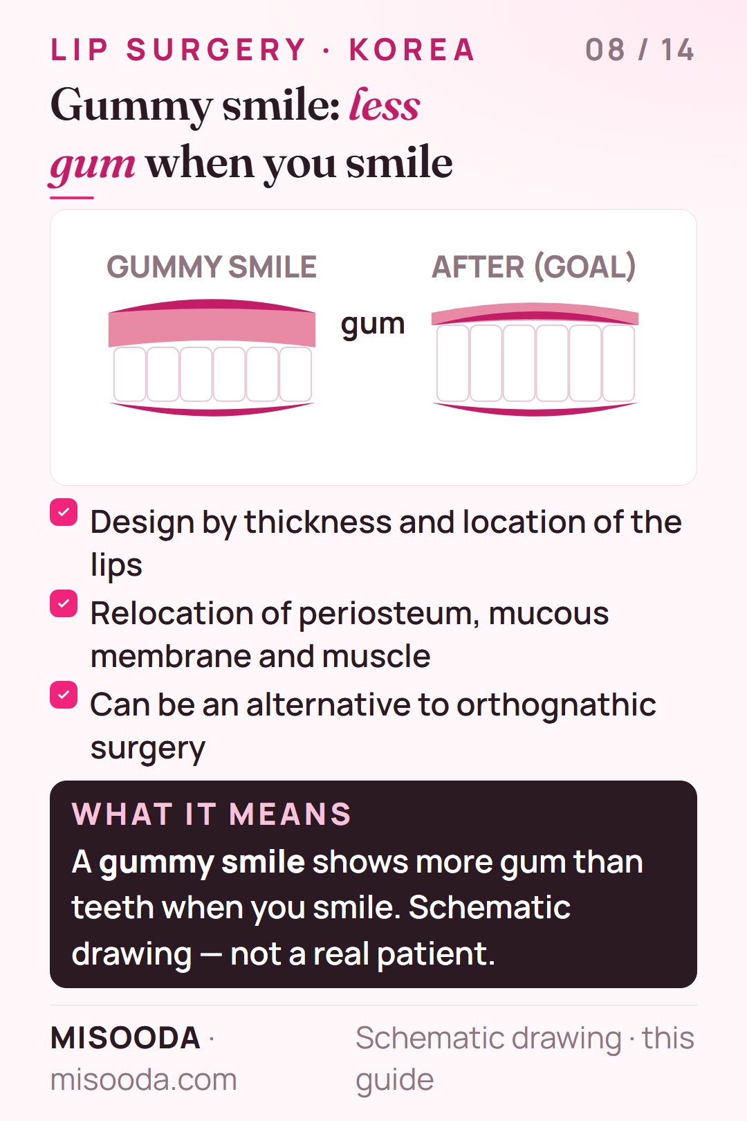 Gummy smile surgery: designed by lip thickness and position, relocating periosteum, mucous membrane and muscle to reduce recurrence; schematic before and goal