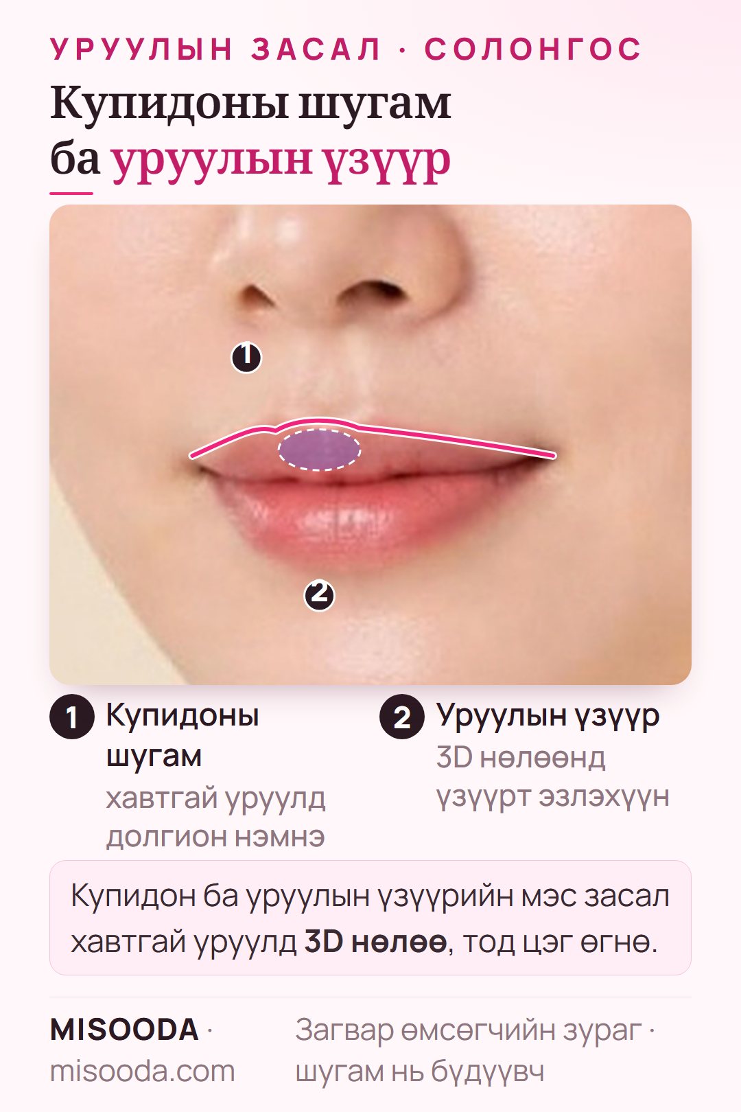Купидоны шугам ба уруулын үзүүрийн мэс засал: хавтгай дээд уруулд долгион нэмж, 3D нөлөөнд уруулын үзүүрт эзлэхүүн өгнө, гуравны дөрөв нүүрэн дээр