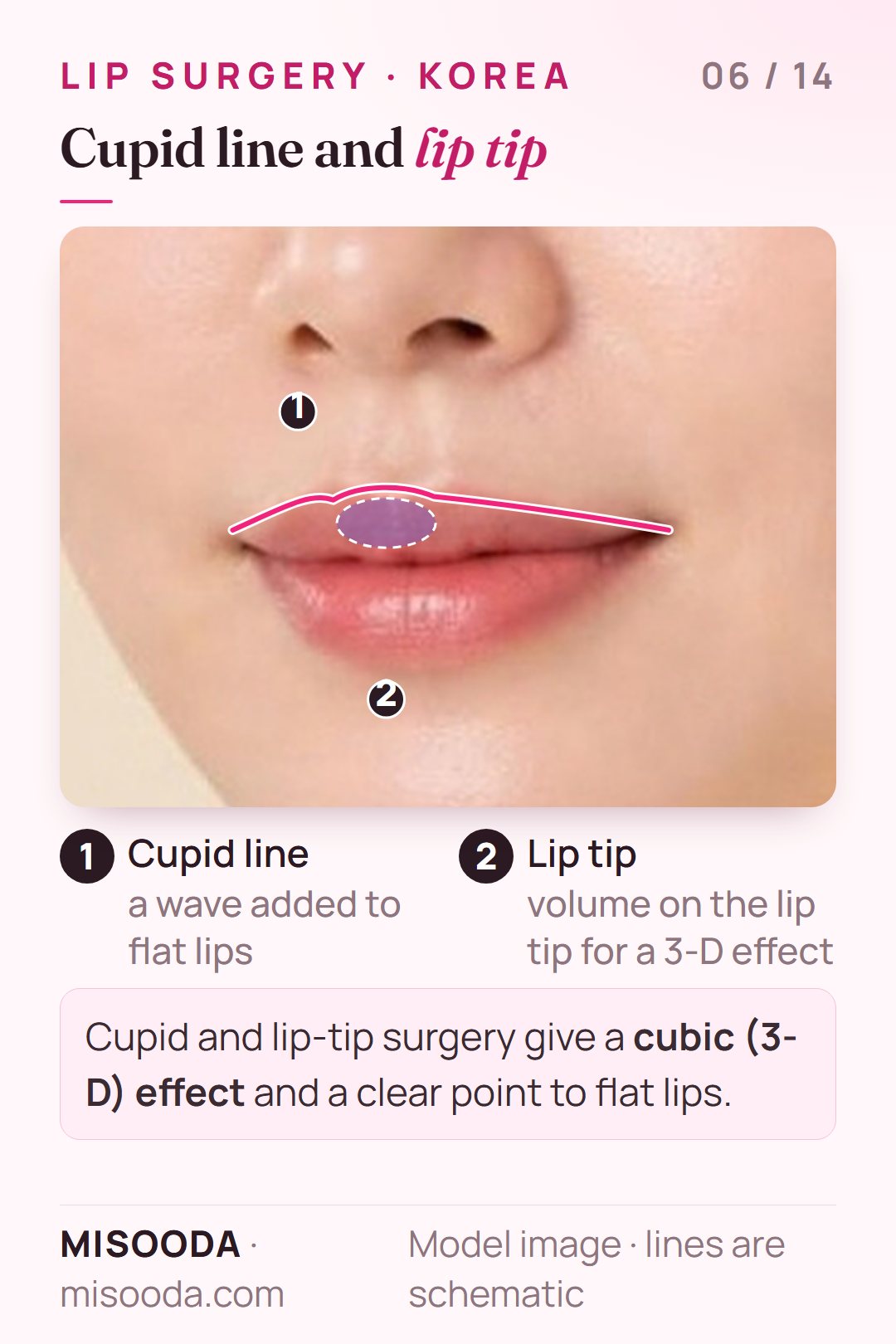 Cupid line and lip tip surgery: a wave added to a flat upper lip and volume on the lip tip for a 3-D effect, drawn on a three-quarter face