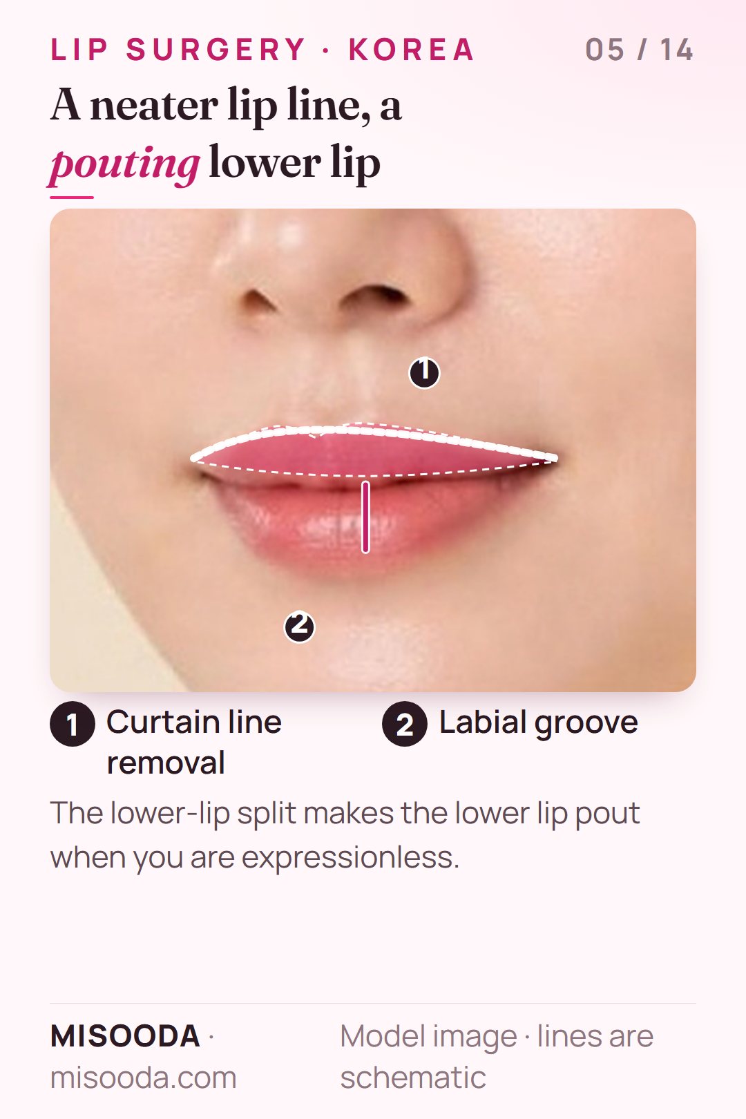 Curtain line removal for a drooping upper lip line and labial groove surgery making a central point on the lower lip, shown on a three-quarter face
