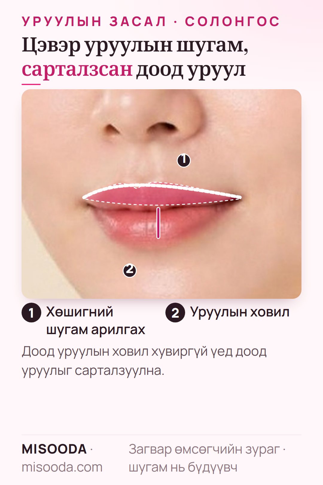 Унжсан дээд уруулын шугамд хөшигний шугам арилгах ба доод уруулын дунд цэг гаргах уруулын ховилын мэс засал, гуравны дөрөв нүүрэн дээр