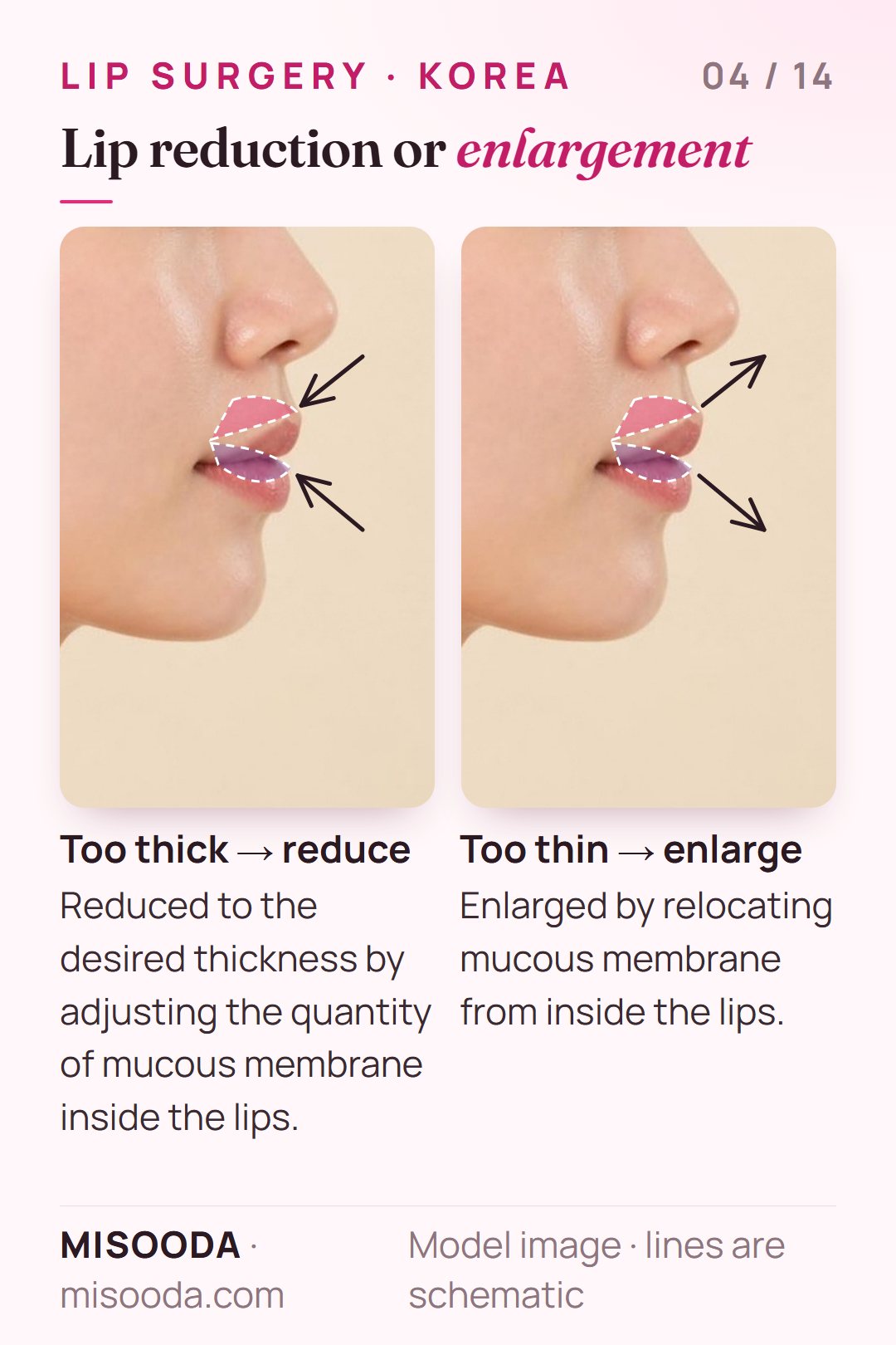 Lip reduction and lip enlargement shown on a side profile: thick lips reduced by adjusting mucous membrane, thin lips enlarged by relocating it
