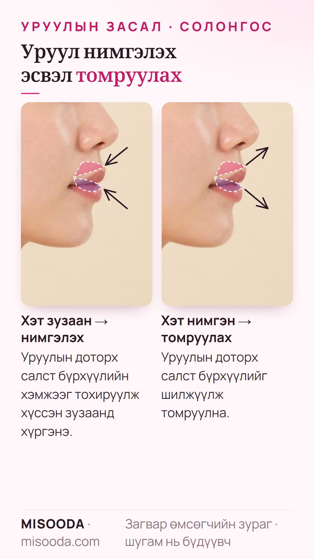 Хажуу дүрс дээрх уруул нимгэлэх ба томруулах: зузаан уруулыг салст бүрхүүлийг тохируулж нимгэлж, нимгэн уруулыг салстыг шилжүүлж томруулна