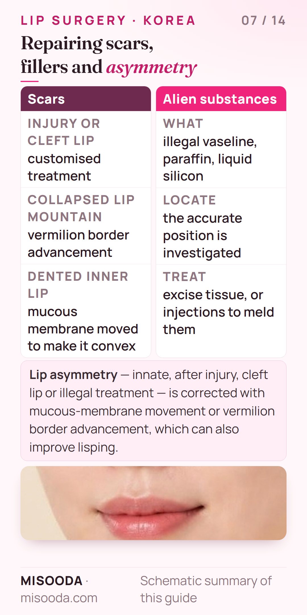 Lip repair surgery: injury or cleft lip scars, removal of illegal vaseline, paraffin or liquid silicone, and correction of lip asymmetry and lisping