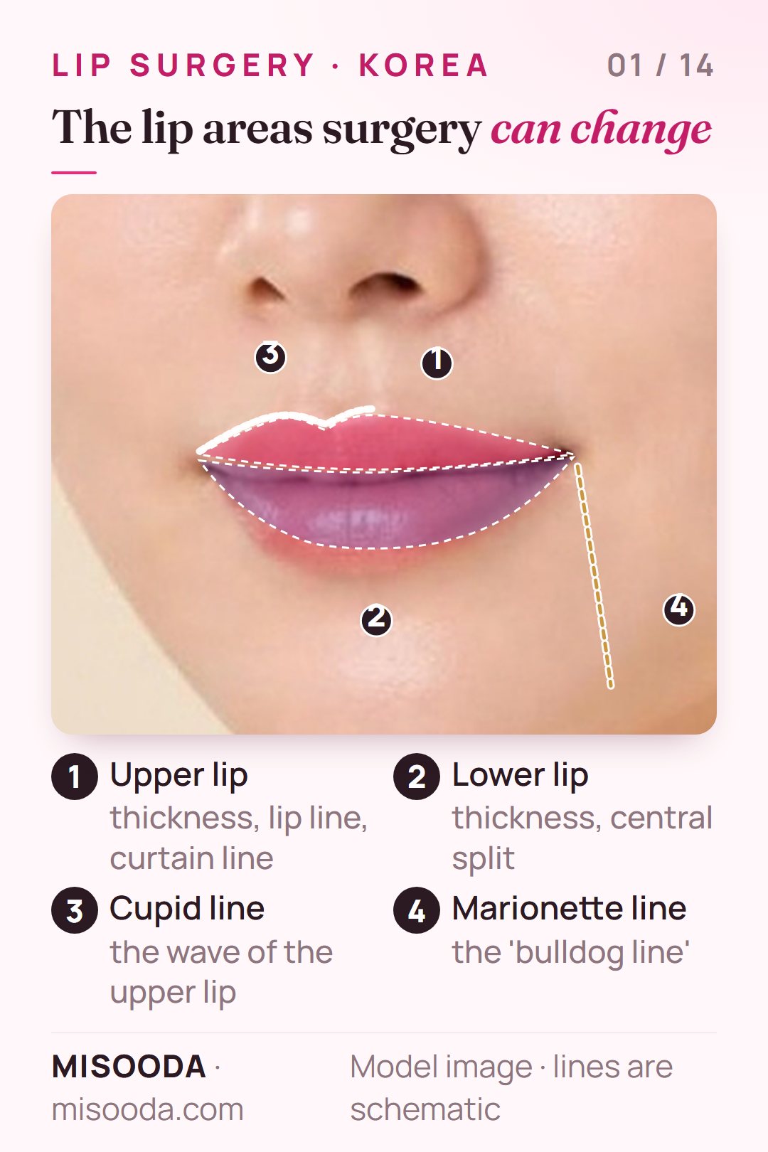 Lip plastic surgery areas on a face: upper lip, lower lip, cupid line and the marionette or bulldog line running down from the mouth corner