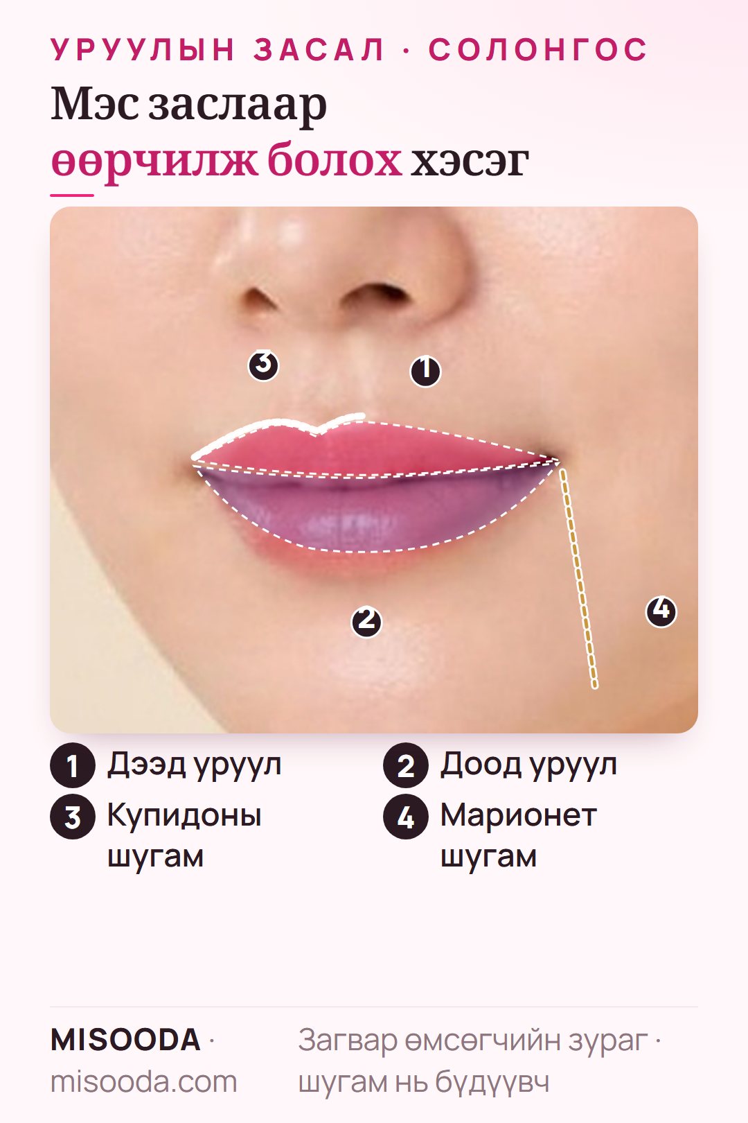 Нүүрэн дээрх уруулын гоо сайхны мэс заслын хэсгүүд: дээд уруул, доод уруул, купидоны шугам, амны булангаас доош гарах марионет буюу бульдог шугам