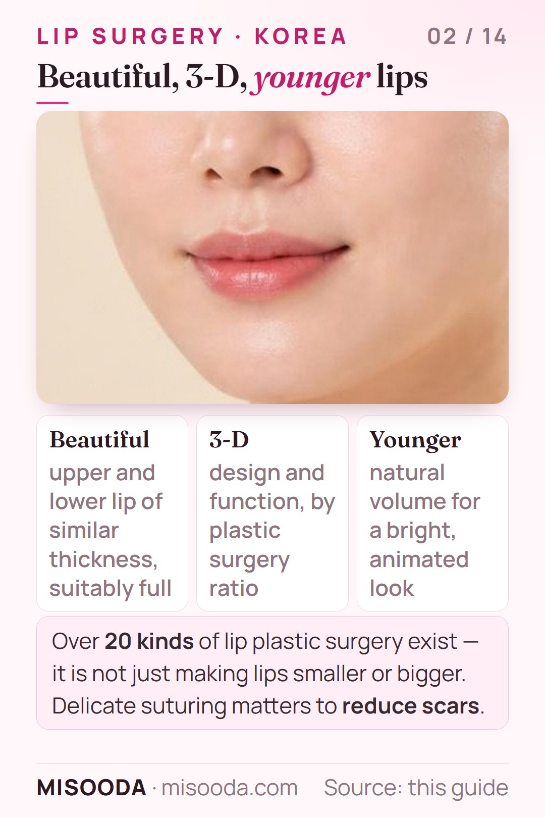 Three characteristics of Korean lip plastic surgery: beautiful balanced upper and lower lips, a 3-D design, a younger look; over 20 kinds of lip surgery