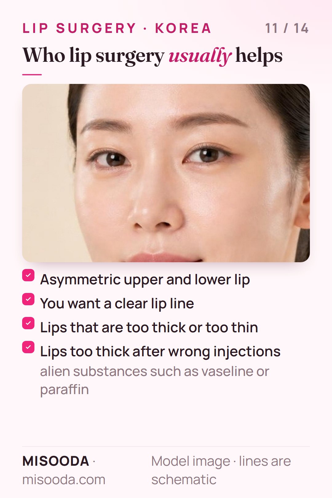 Lip plastic surgery candidates: asymmetric upper and lower lips, wanting a clear lip line, lips too thick or thin, lips too thick after wrong injections