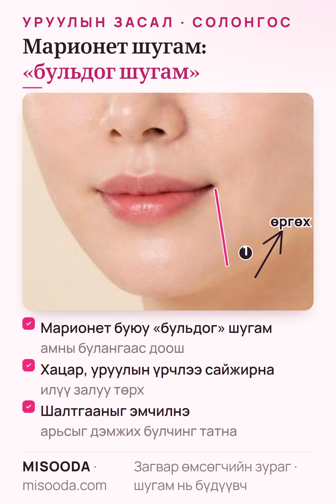 Марионет буюу бульдог шугамын мэс засал: амны булангаас доош гарах шугамыг дэмжих булчинг татаж сайжруулан илүү залуу төрх өгнө
