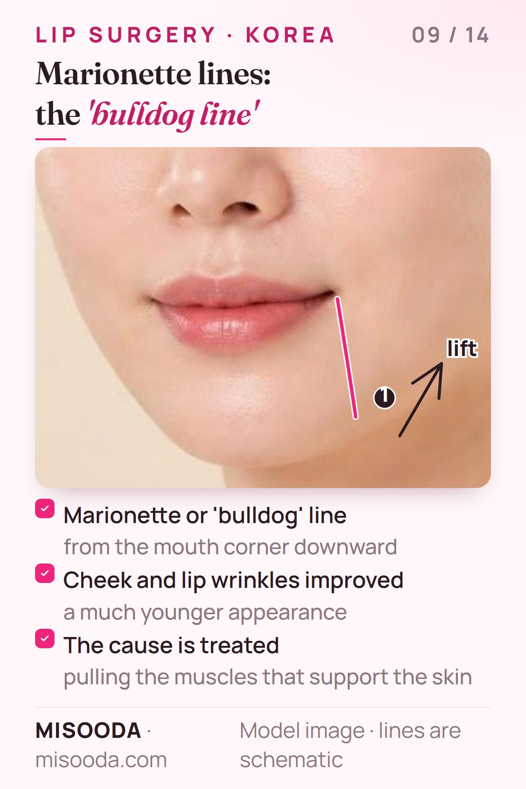 Marionette line or bulldog line surgery: the line running down from the mouth corner is improved by pulling the supporting muscles for a younger look