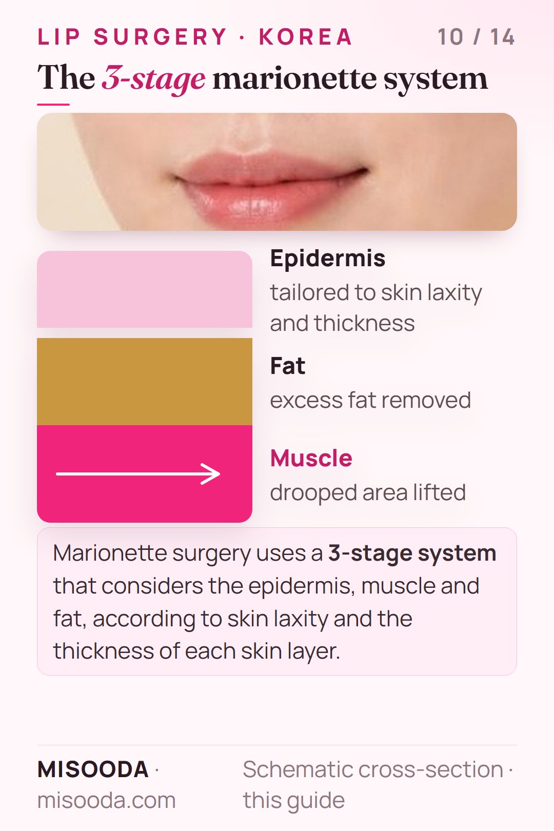 Marionette line surgery 3-stage system: epidermis, fat and muscle considered by skin laxity and layer thickness — fat removed, drooped area lifted