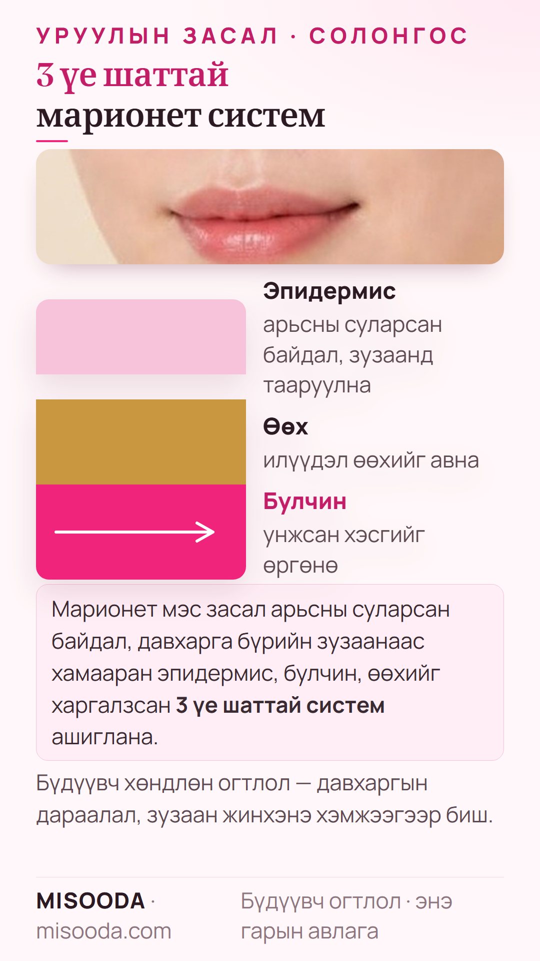 Марионет шугамын мэс заслын 3 үе шаттай систем: арьсны суларсан байдал, давхаргын зузаанаар эпидермис, өөх, булчинг харгалзана — өөх авч, унжсан хэсгийг өргөнө