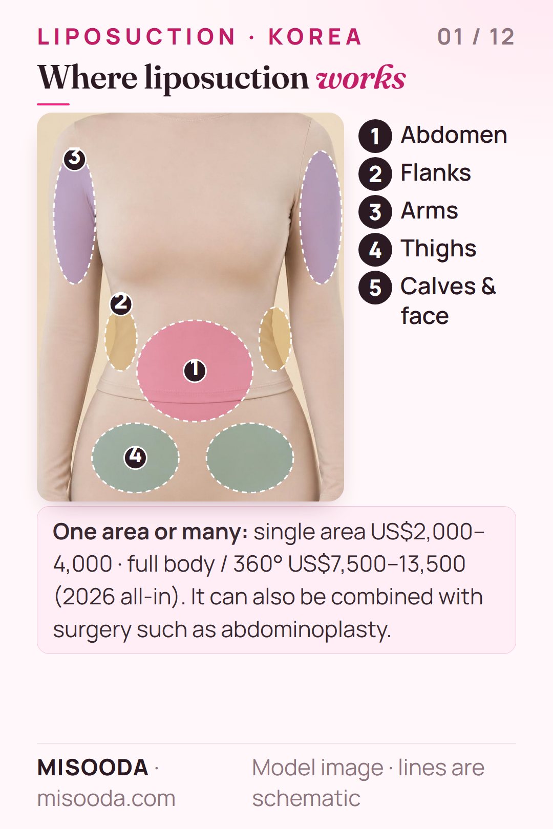 Liposuction treatment areas in Korea shown on a body: abdomen, flanks (love handles), upper arms and thighs, plus calves and face