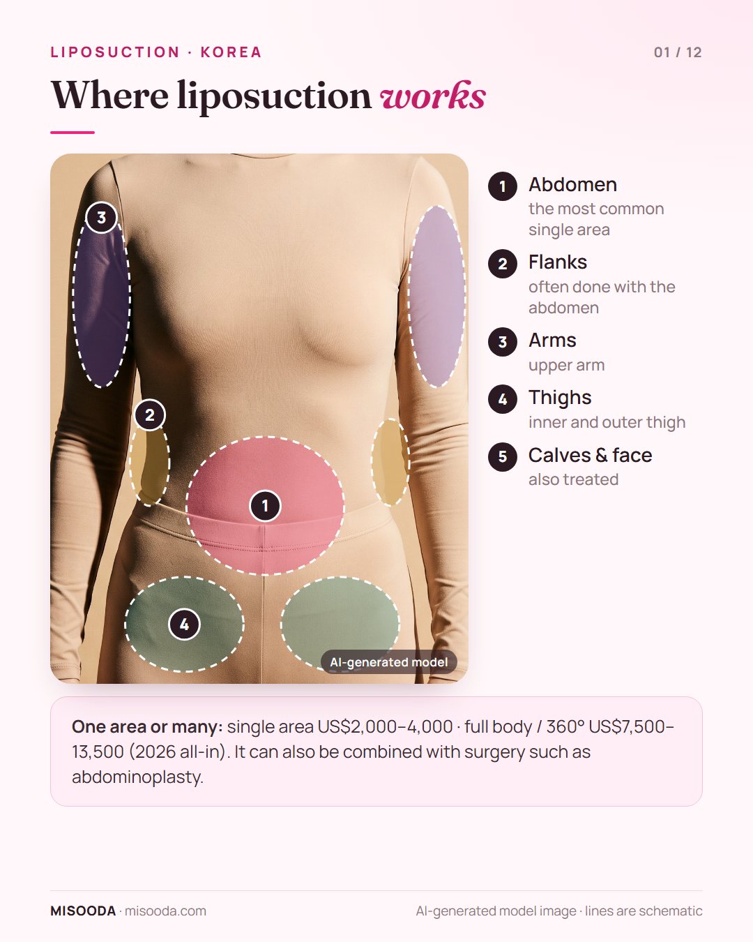Liposuction treatment areas in Korea shown on a body: abdomen, flanks (love handles), upper arms and thighs, plus calves and face