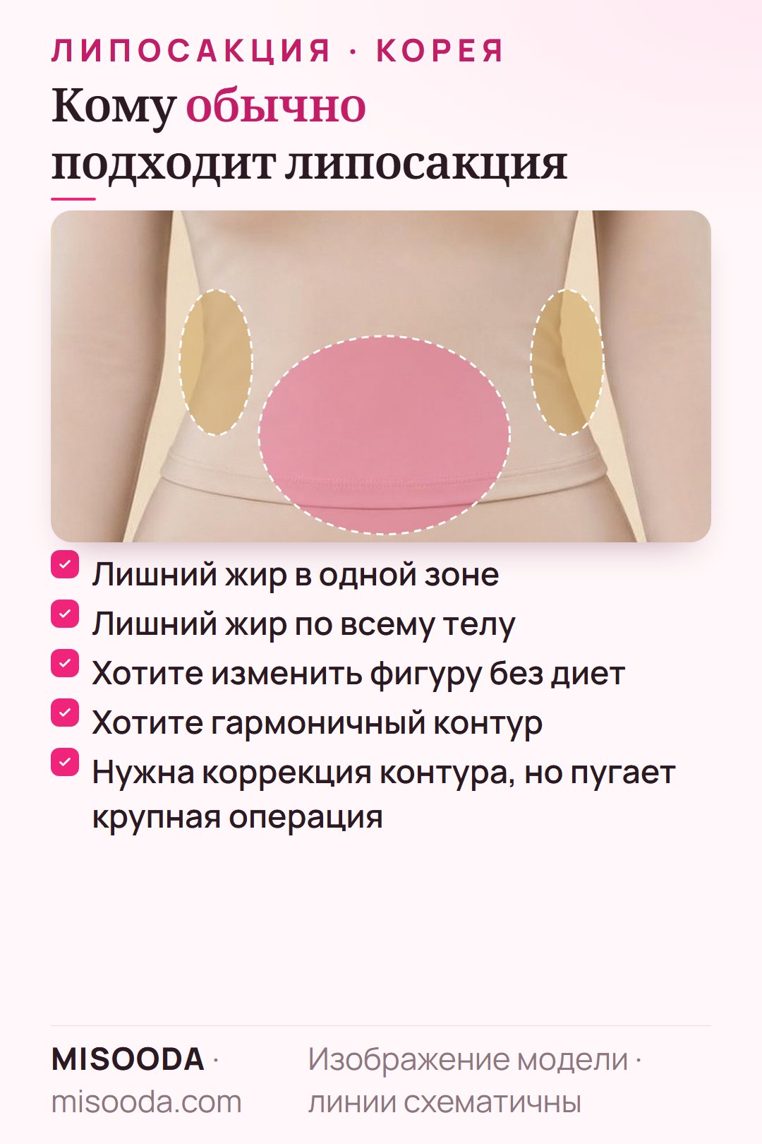 Кому подходит липосакция: лишний жир в одной зоне — на животе, бёдрах или руках, жир по всему телу или желание изменить контуры тела без диет