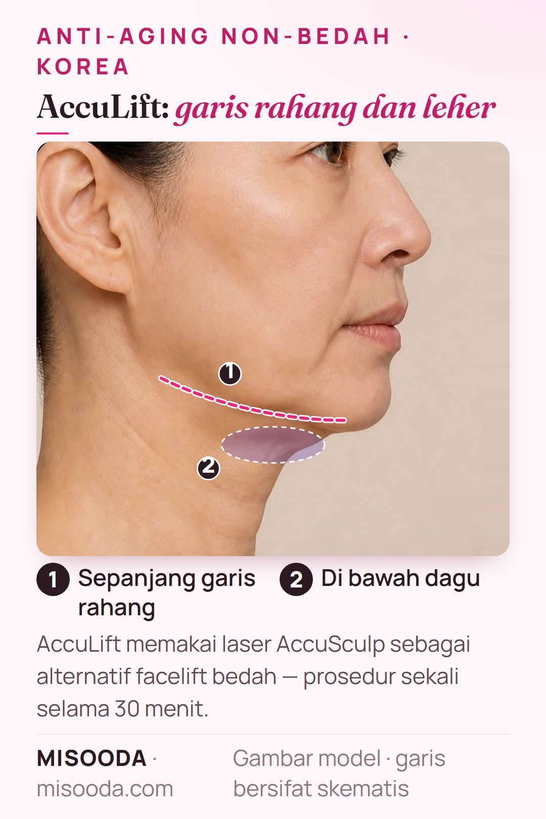 AccuLift dengan laser AccuSculp di Korea: prosedur sekali 30 menit untuk wajah bawah, menangani area di bawah dagu dan sepanjang garis rahang