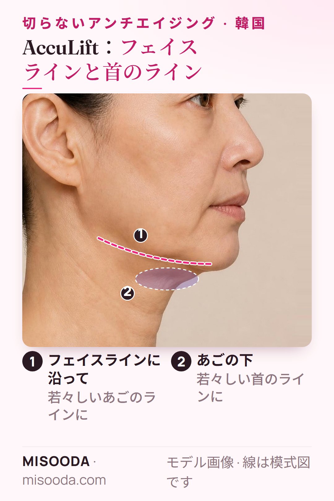 AccuSculpレーザーを使うAccuLift:顔の下半分に一回30分の施術で、あご下とフェイスラインを治療 — 韓国 切らないリフト