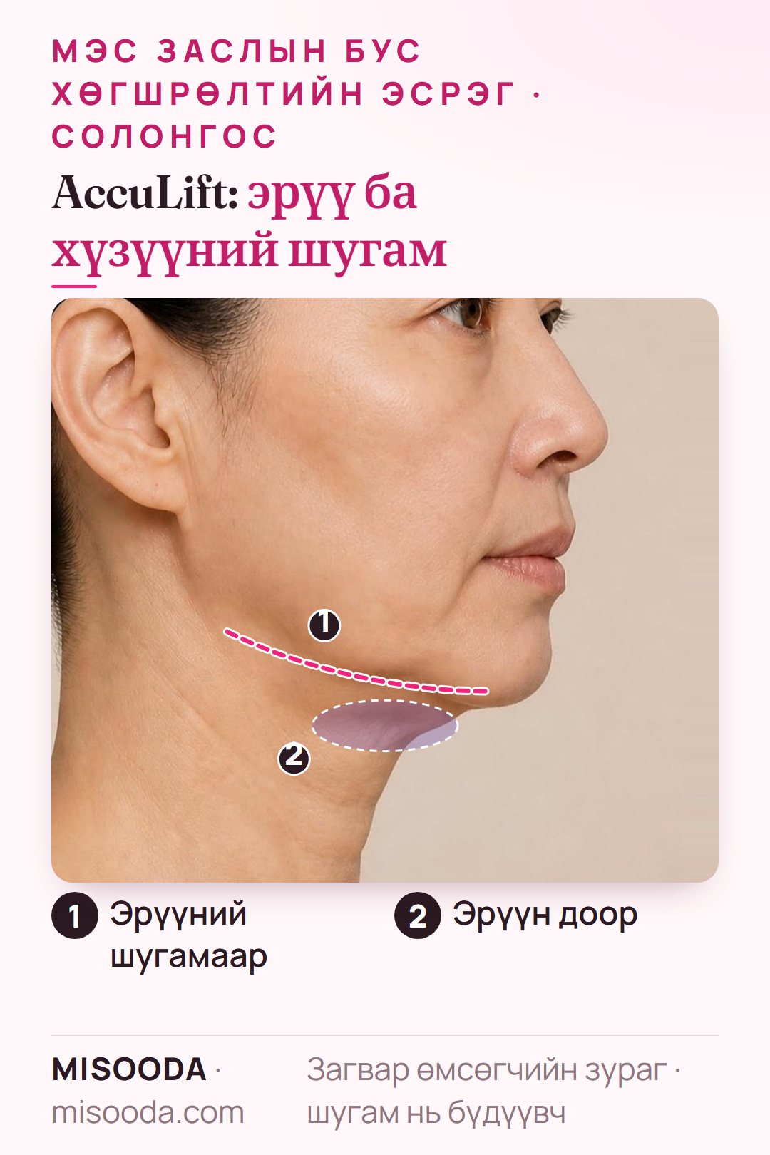 AccuSculp лазертай AccuLift: нүүрний доод хэсэгт нэг удаагийн 30 минутын процедур, эрүүн доор ба эрүүний шугамыг эмчилнэ