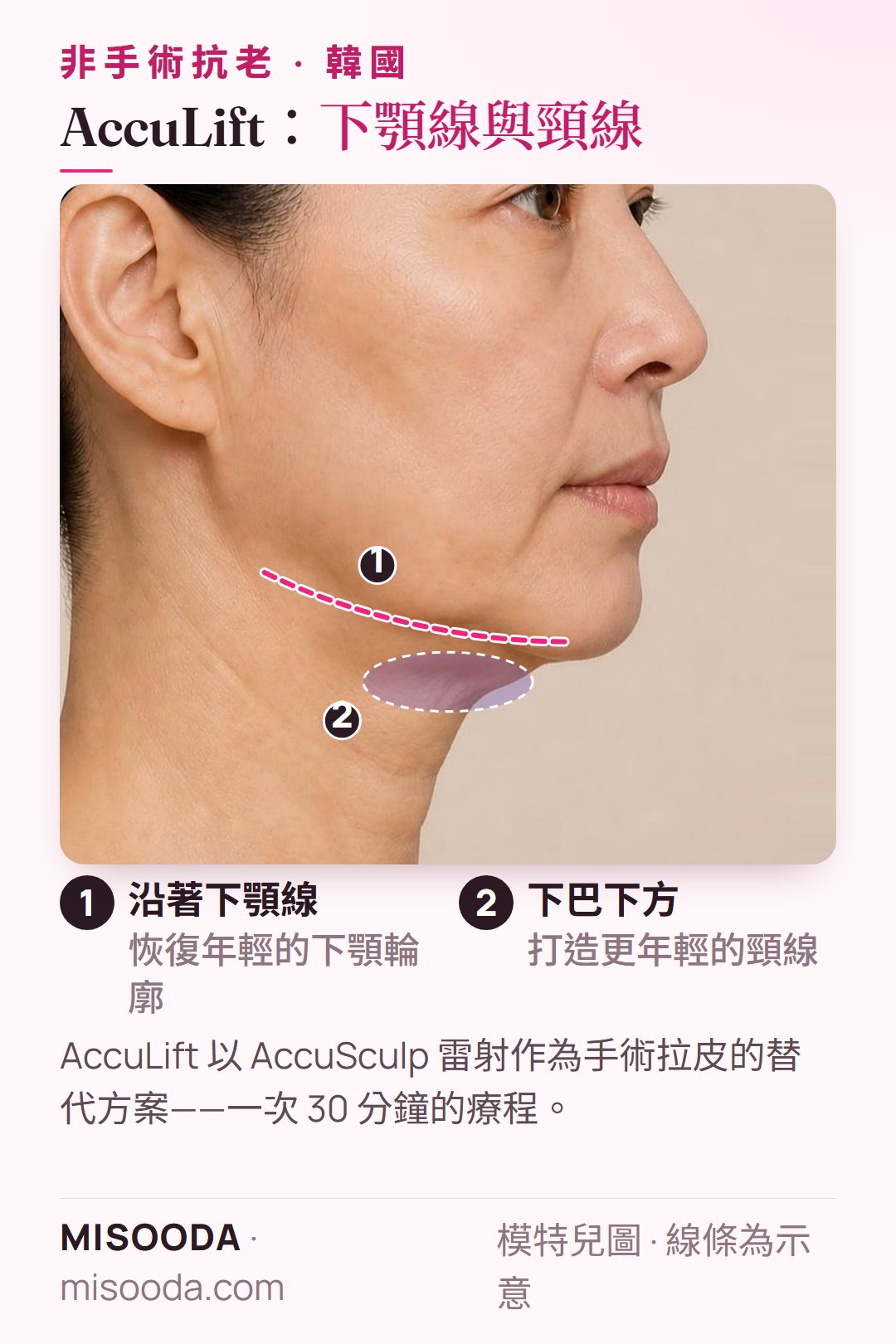 韓國 AccuLift 使用 AccuSculp 雷射:針對下臉部的一次 30 分鐘療程,處理下巴下方與下顎線