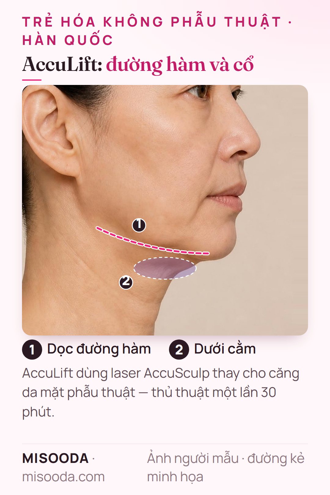 AccuLift với laser AccuSculp: thủ thuật một lần 30 phút cho vùng mặt dưới, điều trị dưới cằm và dọc đường hàm