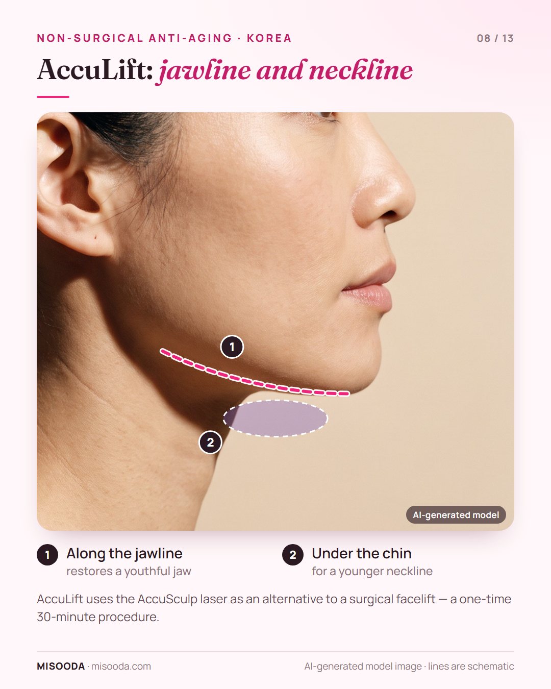 AccuLift with the AccuSculp laser: a one-time 30-minute procedure for the lower face, treating under the chin and along the jawline
