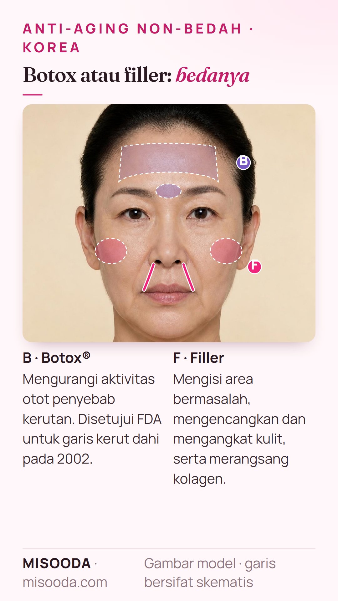 Botox vs filler untuk anti-aging: Botox melemaskan otot penyebab kerutan dahi, disetujui FDA pada 2002; filler mengisi garis senyum dan pipi serta merangsang kolagen