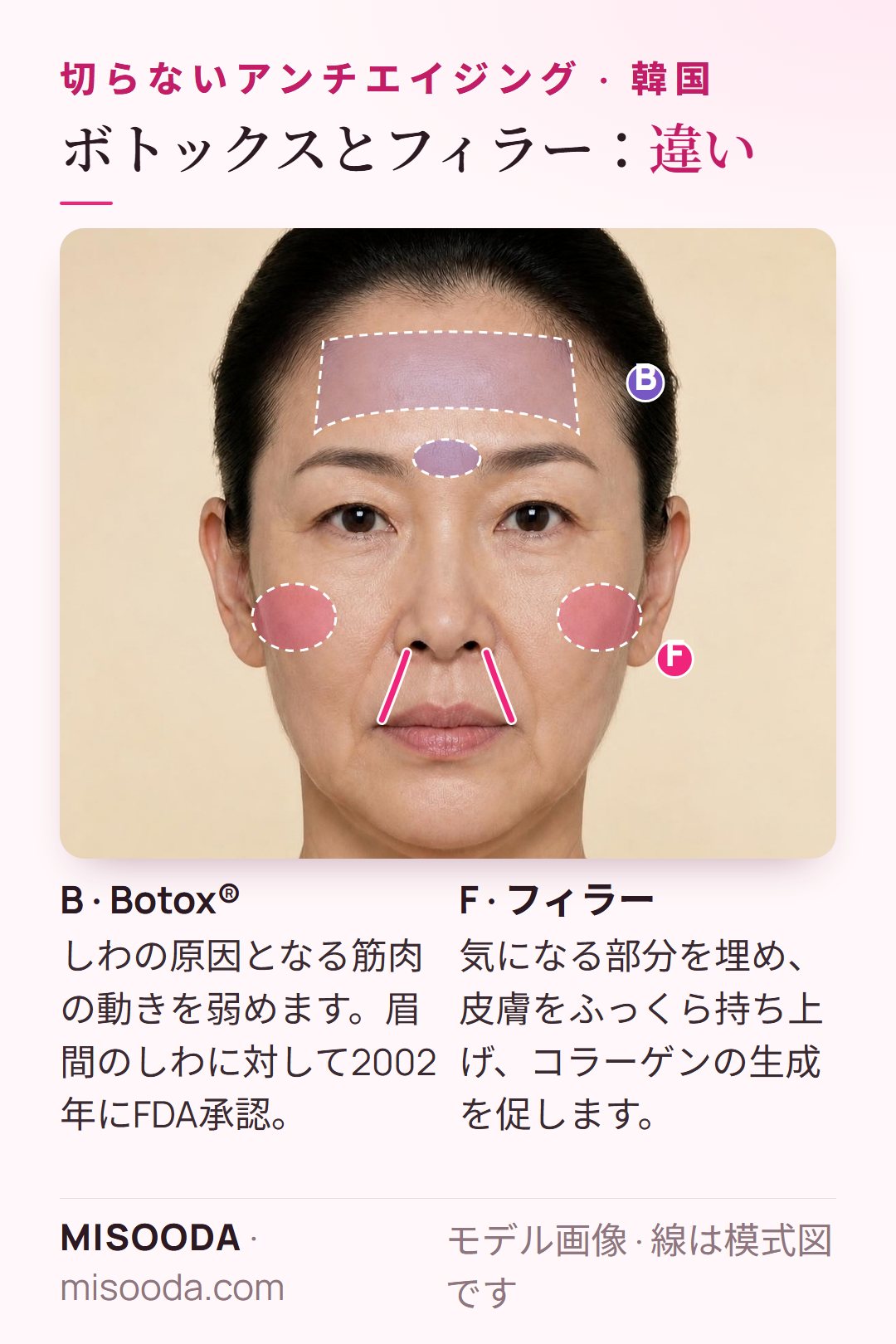 アンチエイジングのボトックスとフィラー:ボトックスは眉間のしわの筋肉をゆるめる(2002年FDA承認)、フィラーはほうれい線や頬をふっくらさせコラーゲンを促す