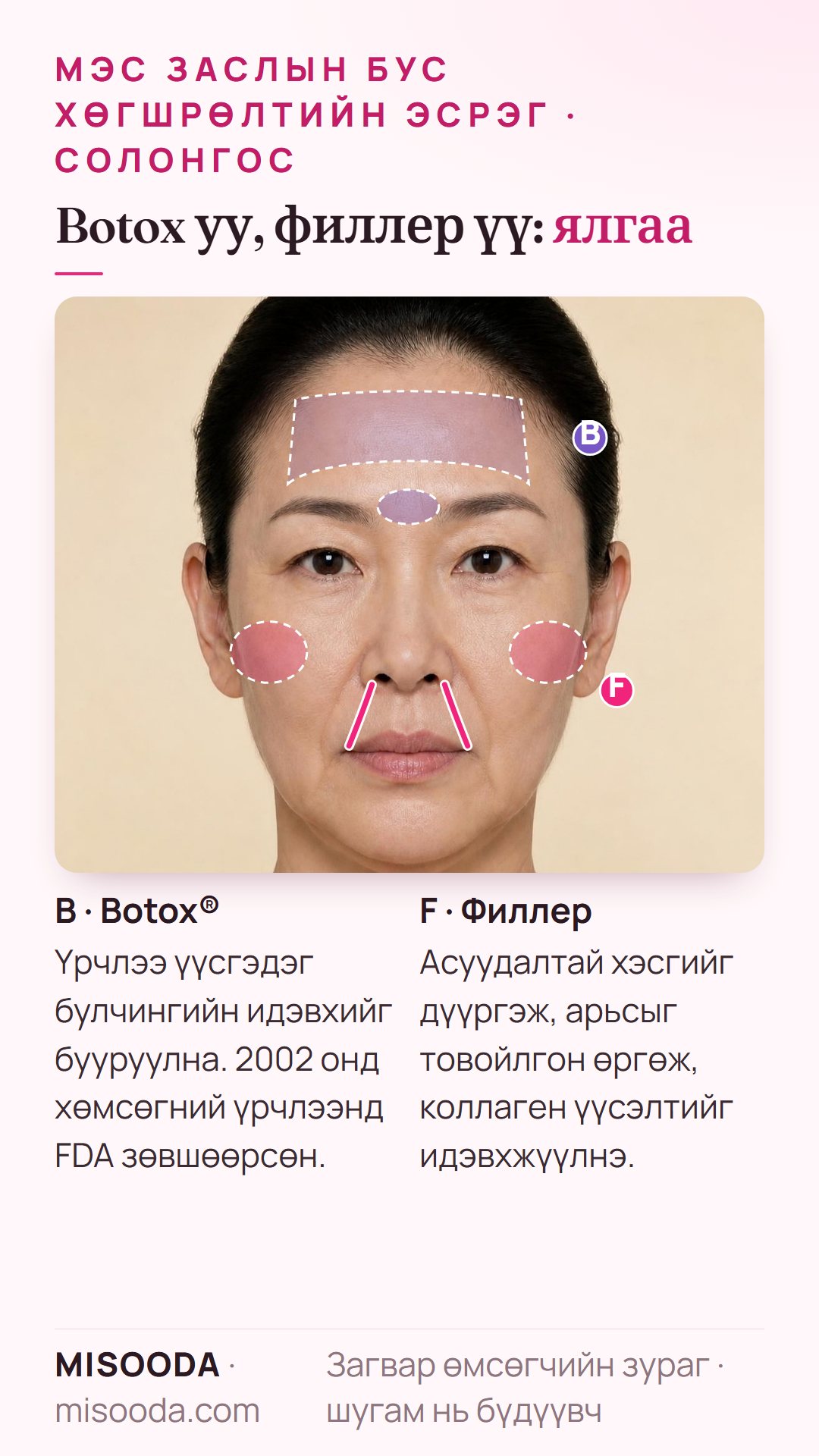 Хөгшрөлтийн эсрэг Botox ба филлер: Botox хөмсөгний үрчлээний булчинг сулруулна, 2002 онд FDA зөвшөөрсөн; филлер инээмсэглэлийн үрчлээ, хацрыг дүүргэж коллаген идэвхжүүлнэ