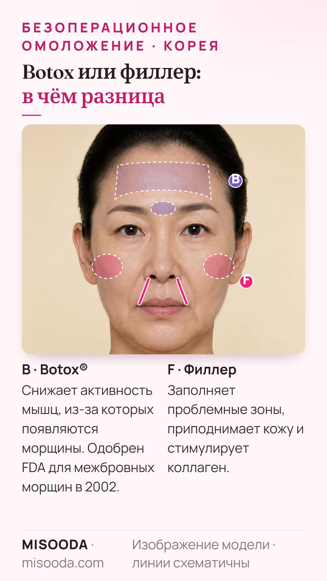 Botox или филлер для омоложения: Botox расслабляет мышцы межбровных морщин, одобрен FDA в 2002; филлеры заполняют носогубные складки и щёки и стимулируют коллаген