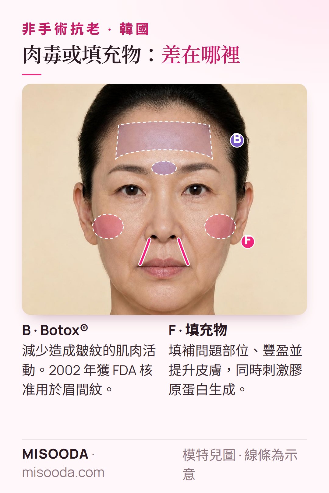 韓國 抗老肉毒 vs 填充物:肉毒放鬆眉間紋背後的肌肉,2002 年獲 FDA 核准;填充物豐盈笑紋與臉頰並刺激膠原蛋白
