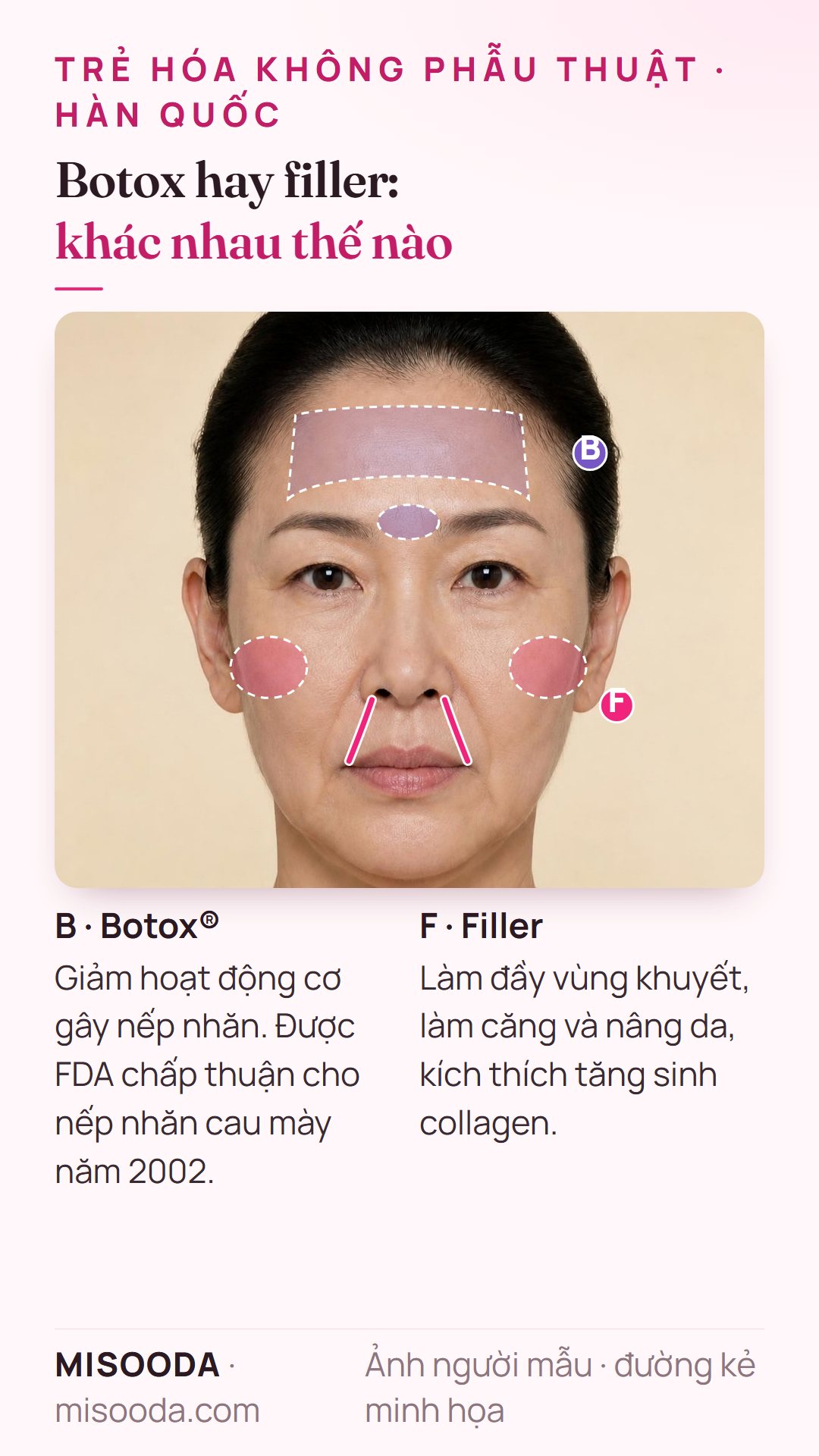 Botox vs filler trẻ hóa: Botox làm giãn cơ gây nếp cau mày, được FDA chấp thuận năm 2002; filler làm đầy rãnh cười, má và kích thích collagen