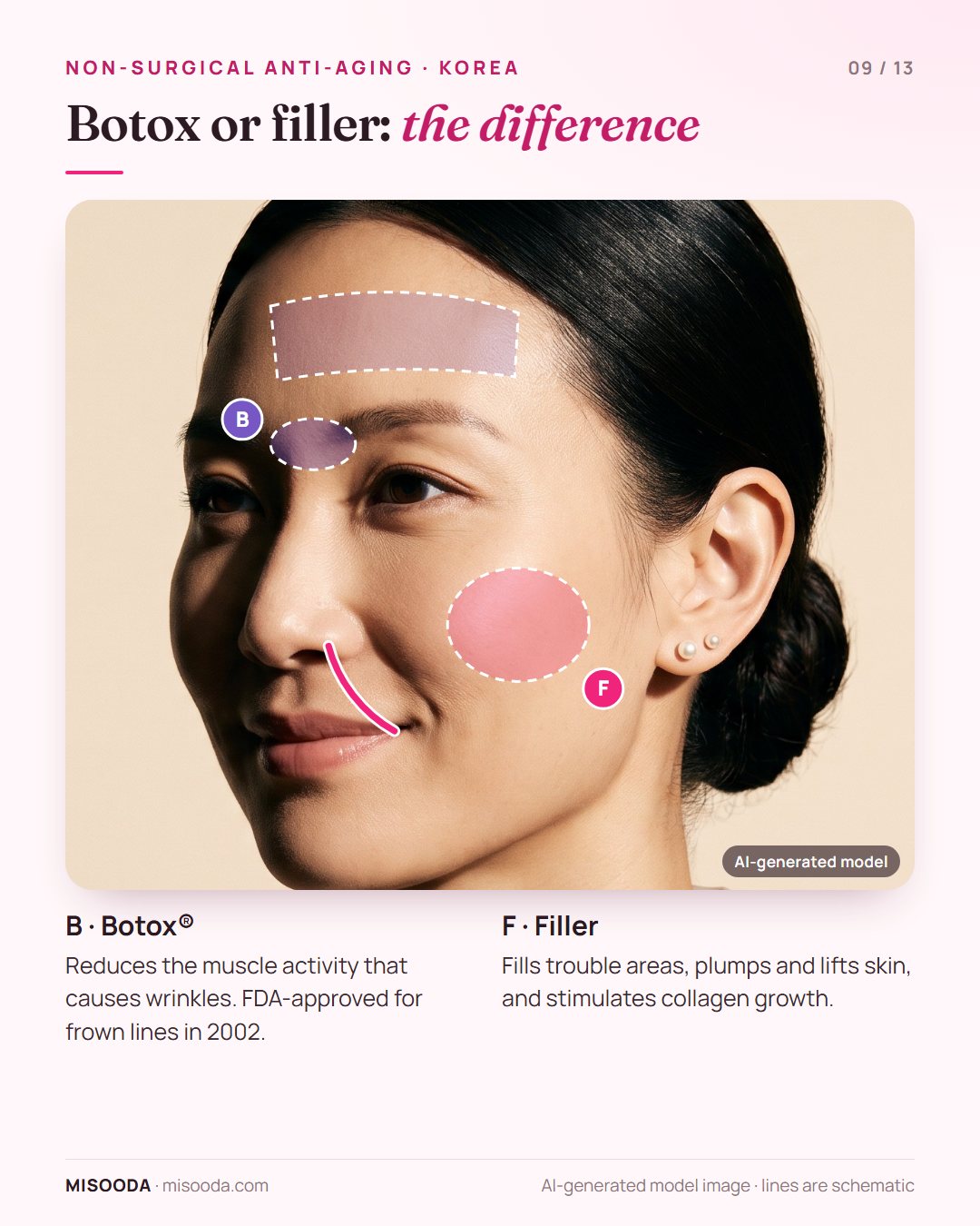 Botox vs filler for anti-aging: Botox relaxes muscles behind frown lines, FDA-approved in 2002; fillers plump smile lines and cheeks and stimulate collagen