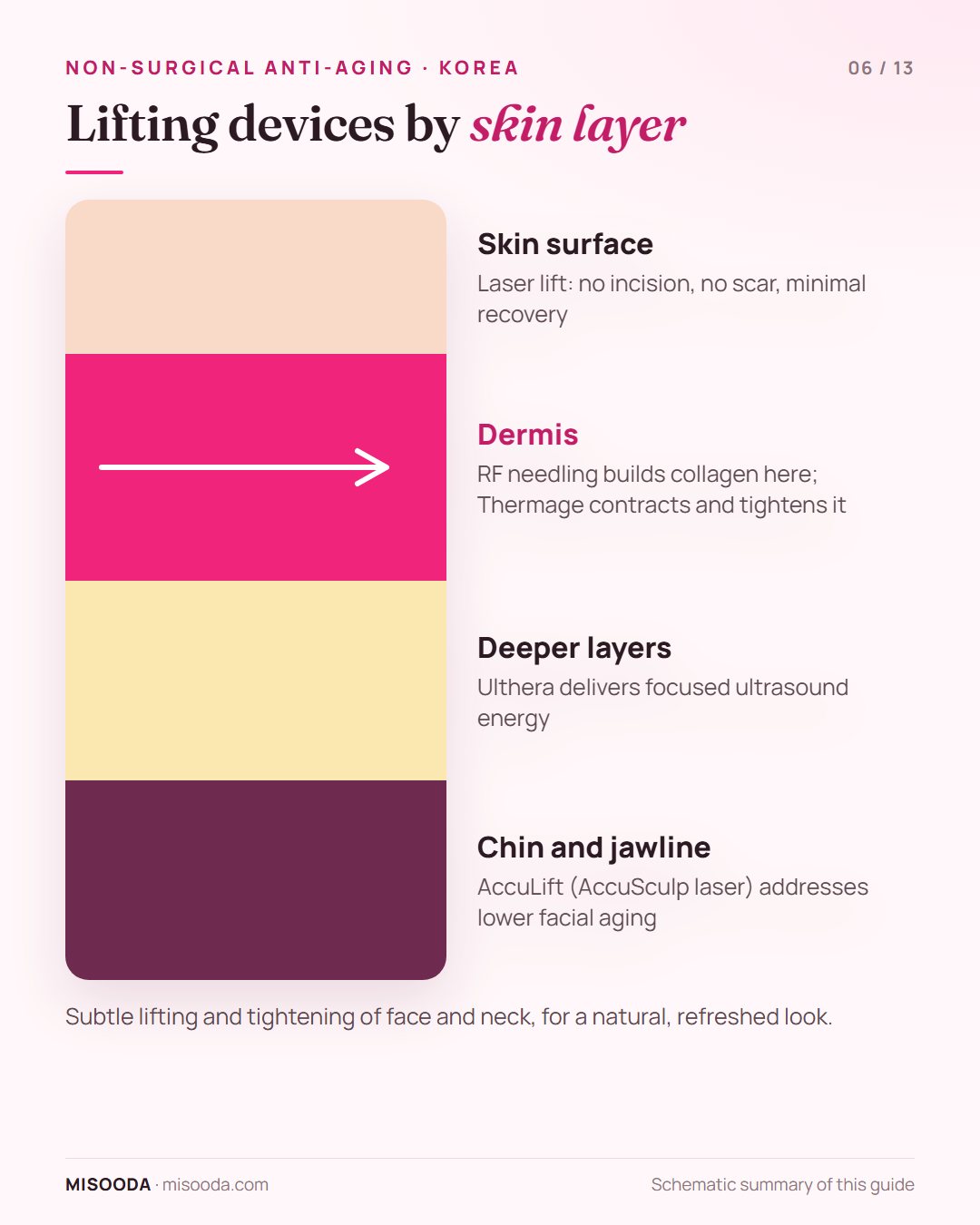 Non-surgical laser lift devices by skin layer: RF needling and Thermage work in the dermis, Ulthera in deeper layers, AccuLift under the chin and jaw