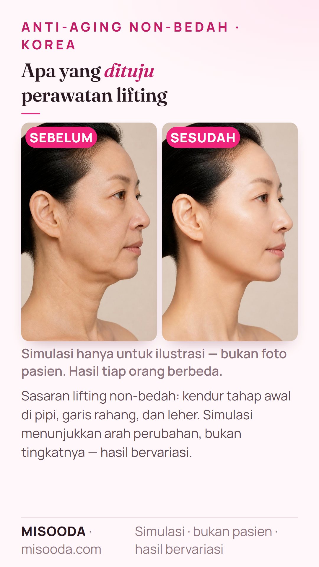 Ilustrasi sasaran umum lifting non-bedah di Korea — kendur tahap awal di pipi, garis rahang, dan leher — disimulasikan pada model, bukan pasien; hanya arah perubahan