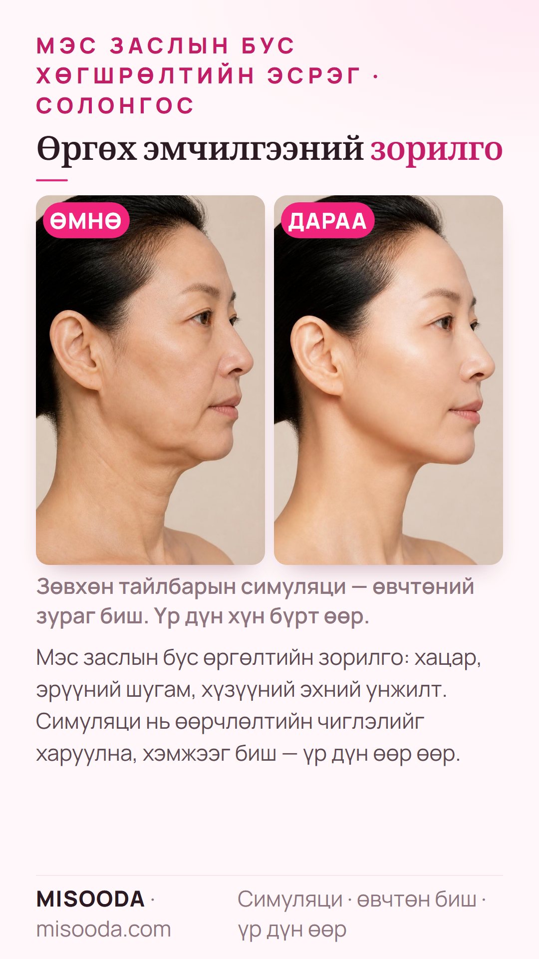 Солонгост мэс заслын бус өргөлтийн ердийн зорилгын зураг — хацар, эрүүний шугам, хүзүүний эхний унжилт — загвар дээрх симуляци, өвчтөн биш; зөвхөн чиглэл